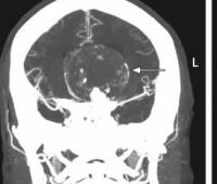 Near Complete Giant Intracranial Aneurysm Mimicking Anaplastic Glioma: A Rare Case Report and Surgical Management