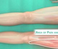 Diagnosis and Treatment of Meralgia Paresthetica (Literature Review)