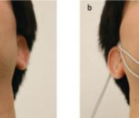 Electromyographic Study for Swallowing Muscles in Normal and TMD Patients