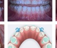 Innovative Protocol for Early Class III Correction with Aligner and Facemask: A Case Report