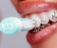 Gingival Recession Due to Orthodontic Treatment: Prevention and Treatment Methods