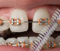 Metals Used in Orthodontics and Their Side Effects