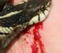 From Bite to Bleed-out: Managing Vasculotoxic Snakebite Induced Catastrophic Complications in Resource Constrained Settings 