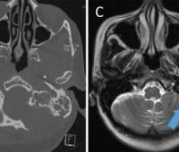 Rhinorrhoea Secondary to Spontaneous Cerebrospinal Fluid Leak: A Case Report