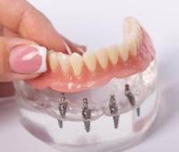 Comprehensive Overview of the Benefits of Implant-Supported Dentures