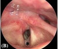 When Cancer Resurfaces: Late Metastasis After Partial Laryngectomy