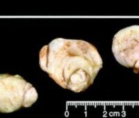 Uterine Intravascular Leiomyomatosis Extending to the Inferior Vena Cava and Right Heart Chamber