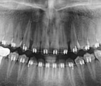 Awareness Level of Post Extraction Malocclusion Among Patients Attending University of Rwanda Dental Teaching Clinic